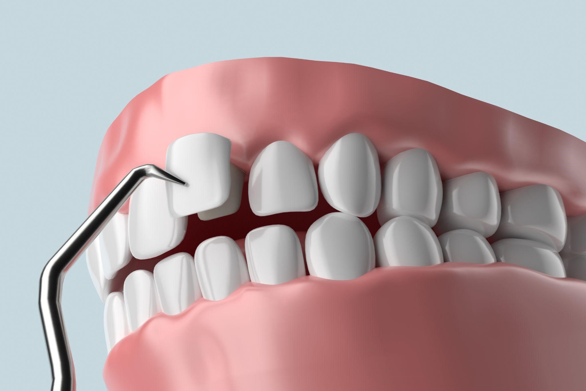 The Process of Getting Dental Veneers