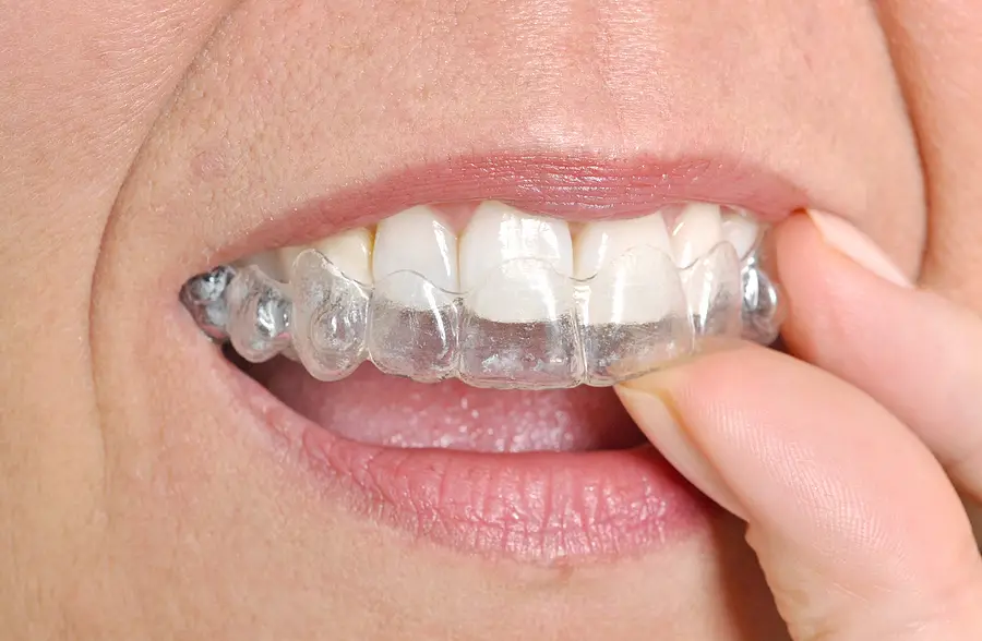 Straighten Your Smile with Almost Invisible Braces in Pasadena, TX