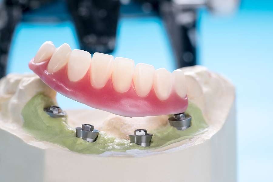General Dentist: A Guide to Dental Implants
