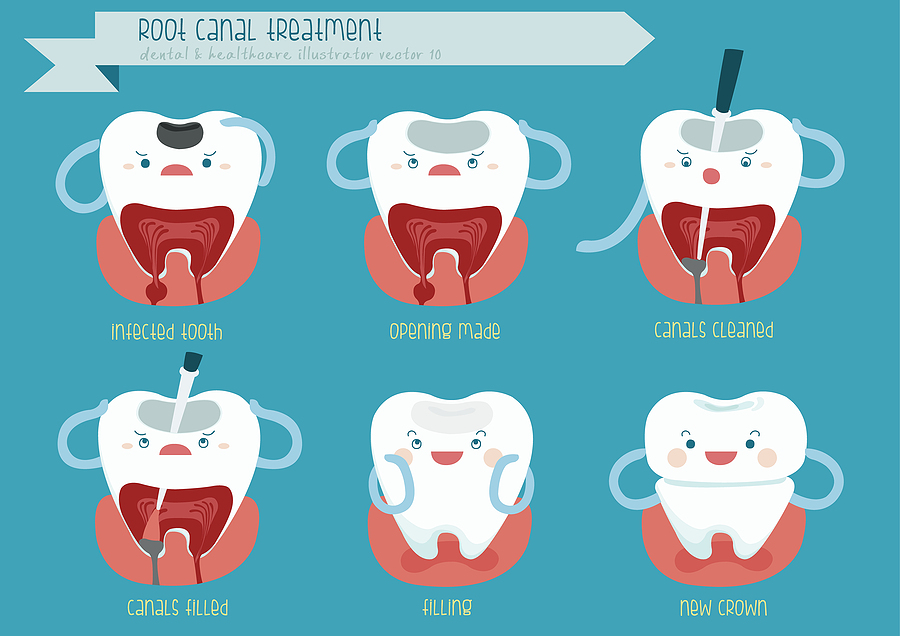 Saving Your Smile: A Comprehensive Guide to Root Canal Treatment in Pasadena, TX